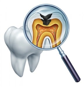 How Do Cavities Start?