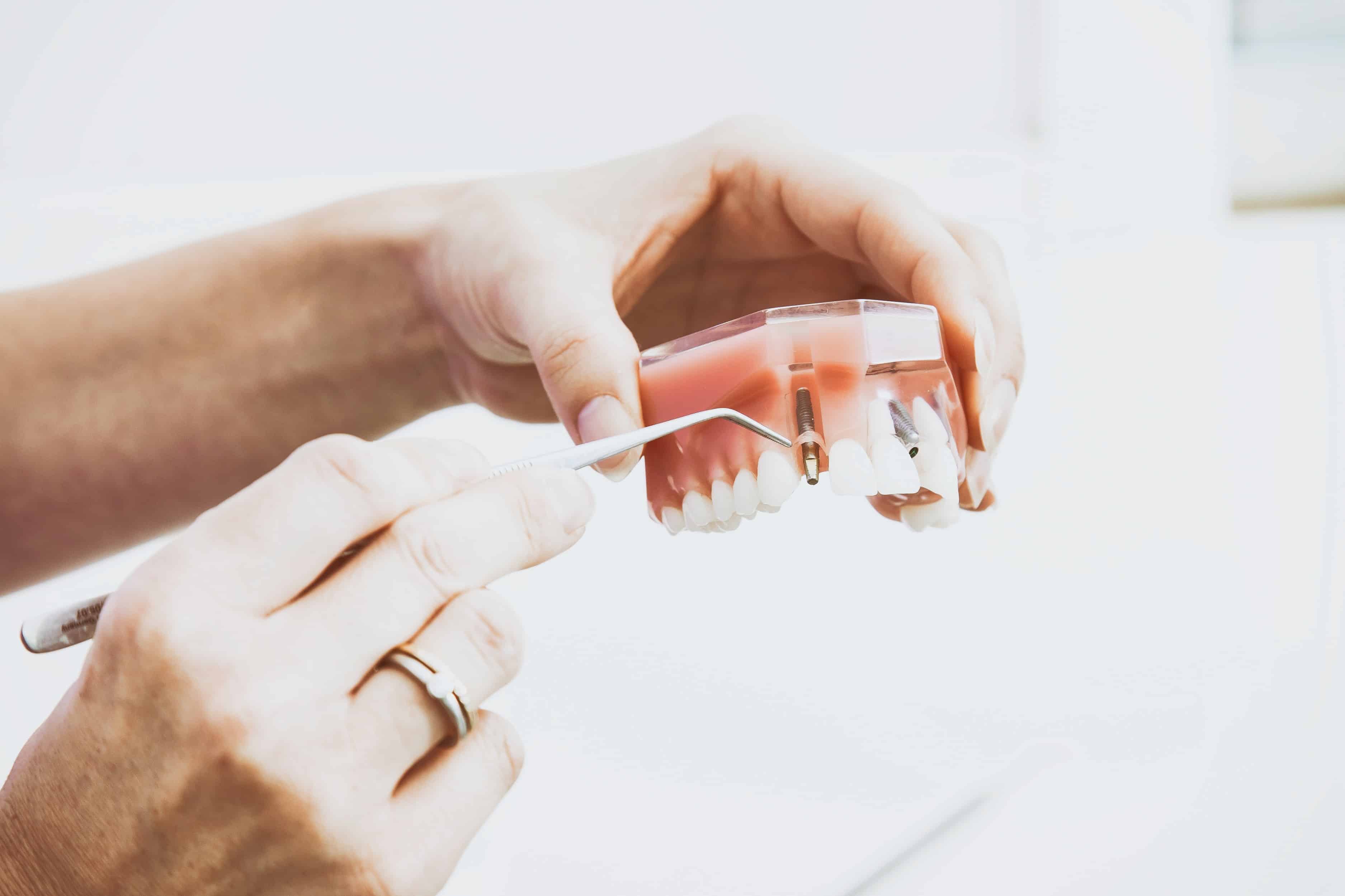 Ultimate Guide to Dental Implants