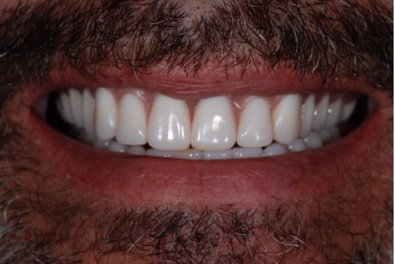 after dental implants in Lakeway, TX