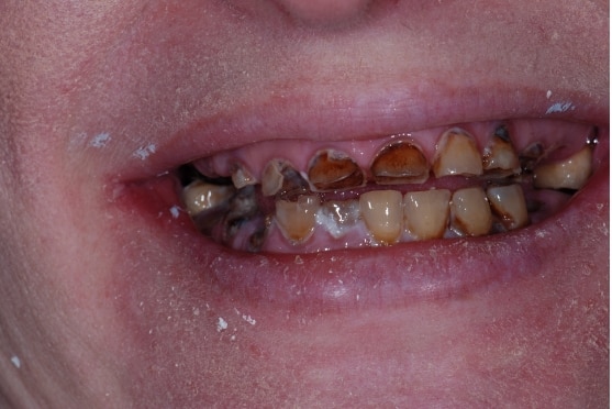 before dental implants in Lakeway, TX