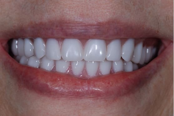 after dental implants in Lakeway, TX