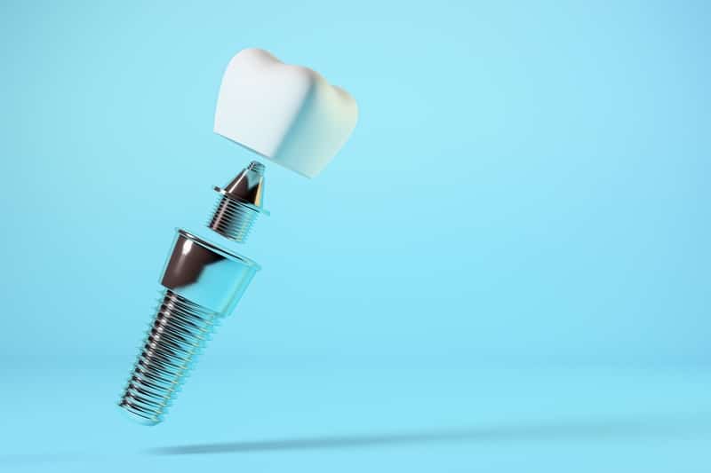 dental implant close up